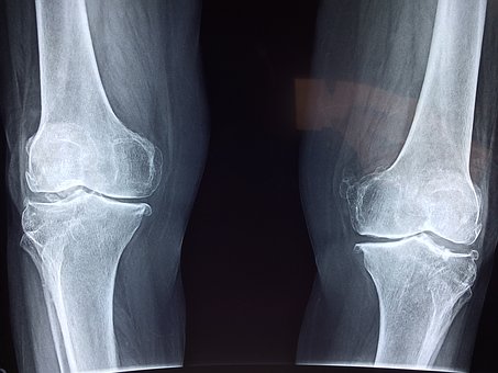 Otok kolene po operaci menisku